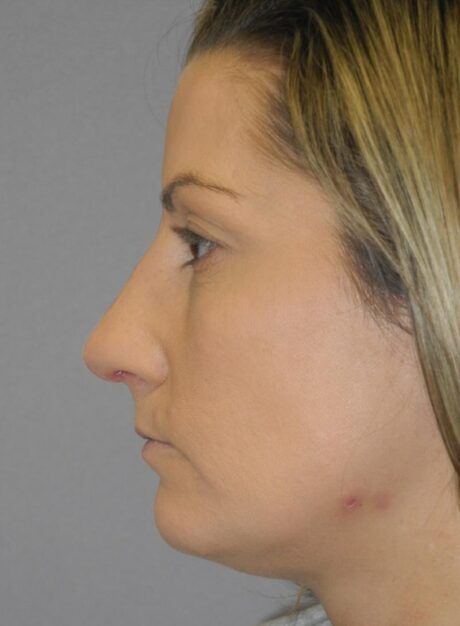 Rhinoplasty case #4123