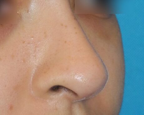 Liquid Rhinoplasty case #4124