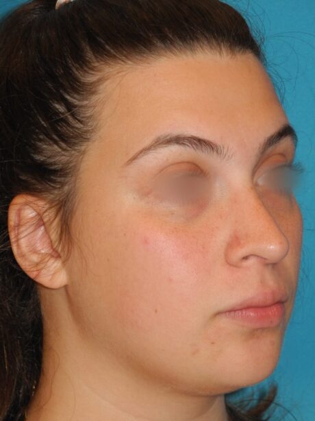 Rhinoplasty case #4126