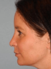 Rhinoplasty case #3690