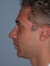 Revision Rhinoplasty case #3492