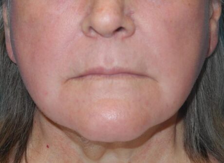 CO2 Laser Resurfacing case #4511