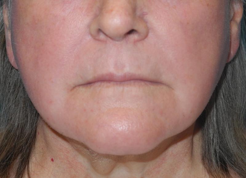 CO2 Laser Resurfacing case #4511