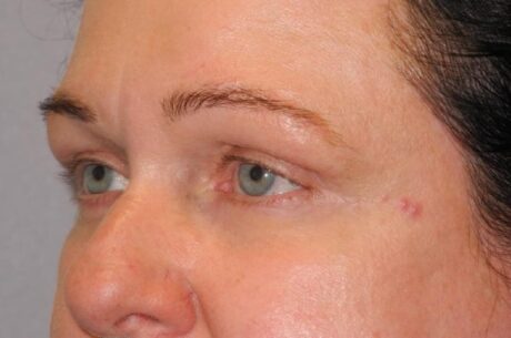 CO2 Laser Resurfacing case #4586