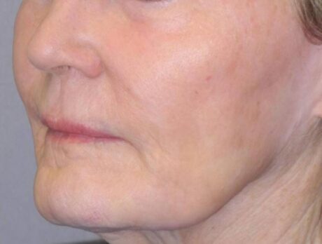 CO2 Laser Resurfacing case #4638