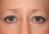 Blepharoplasty case #5003