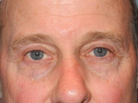 Blepharoplasty case #5018