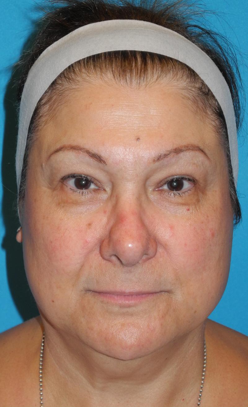 Blepharoplasty case #5141