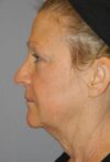 Blepharoplasty case #5153