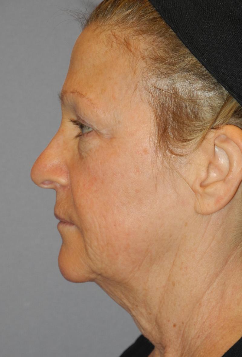 Blepharoplasty case #5153