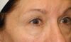 Blepharoplasty case #5167