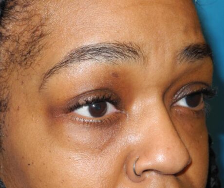 Blepharoplasty case #5204