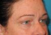 Blepharoplasty case #5225