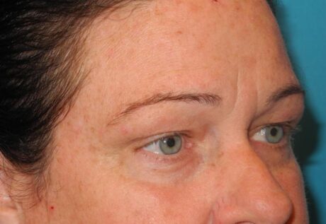 Blepharoplasty case #5225