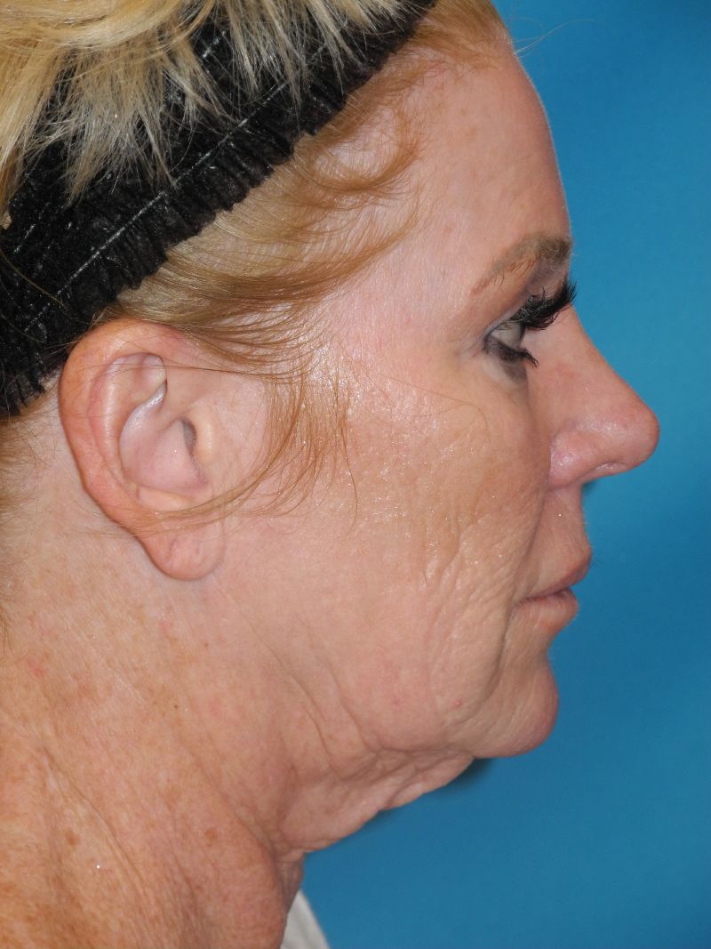 Blepharoplasty case #5235