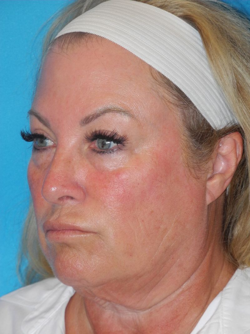 Blepharoplasty case #5252