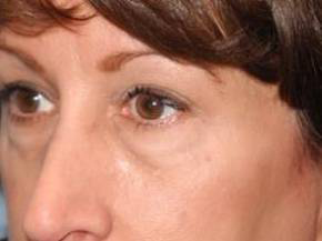 Blepharoplasty case #4065