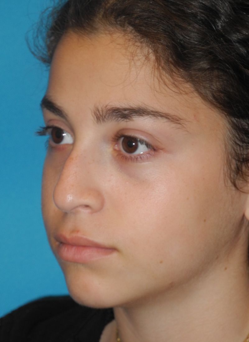 Rhinoplasty case #3525