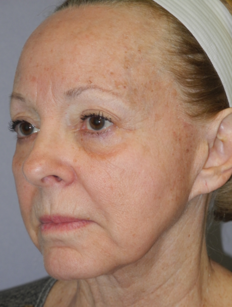 CO2 Laser Resurfacing case #4684