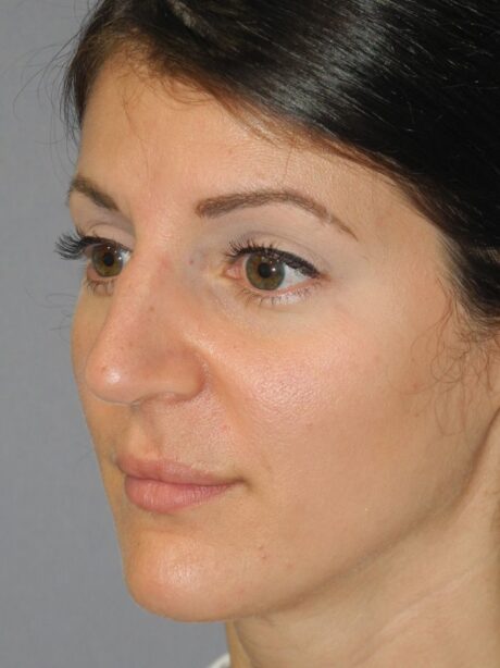 Rhinoplasty case #3680