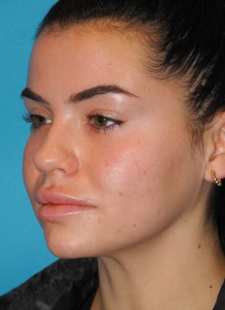 Rhinoplasty case #3681