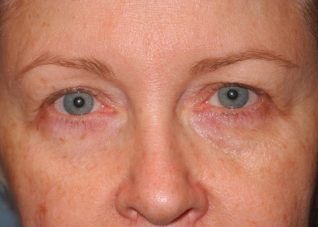 Blepharoplasty case #4986