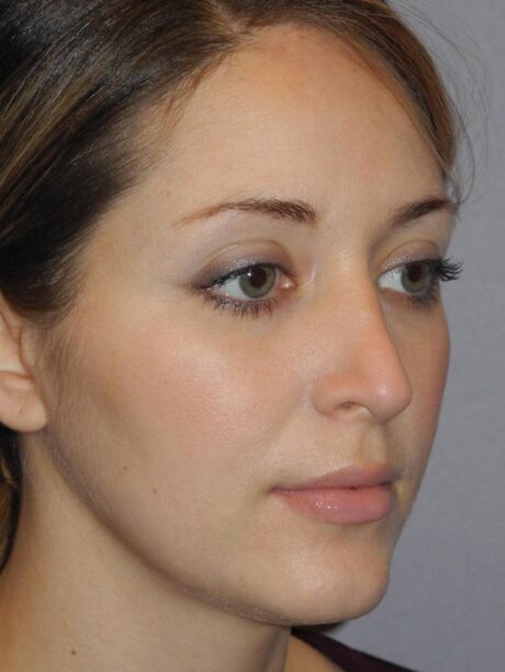 Rhinoplasty case #3685