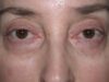 Blepharoplasty case #3843