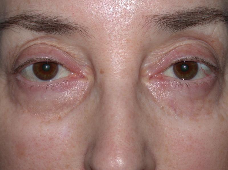 Blepharoplasty case #3843