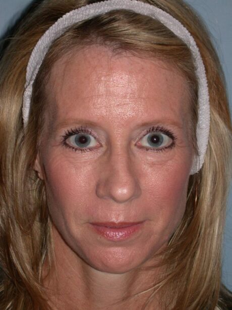 Blepharoplasty case #3938