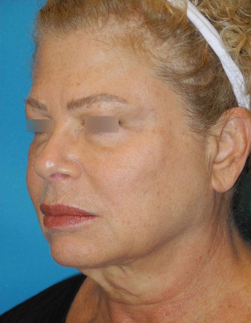 Blepharoplasty case #3989