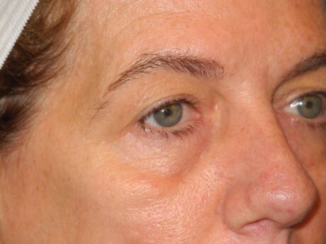 Blepharoplasty case #6472