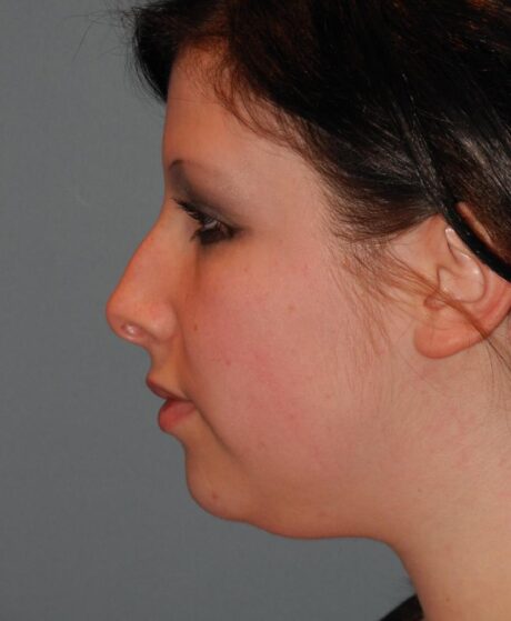 Chin Implant case #4121