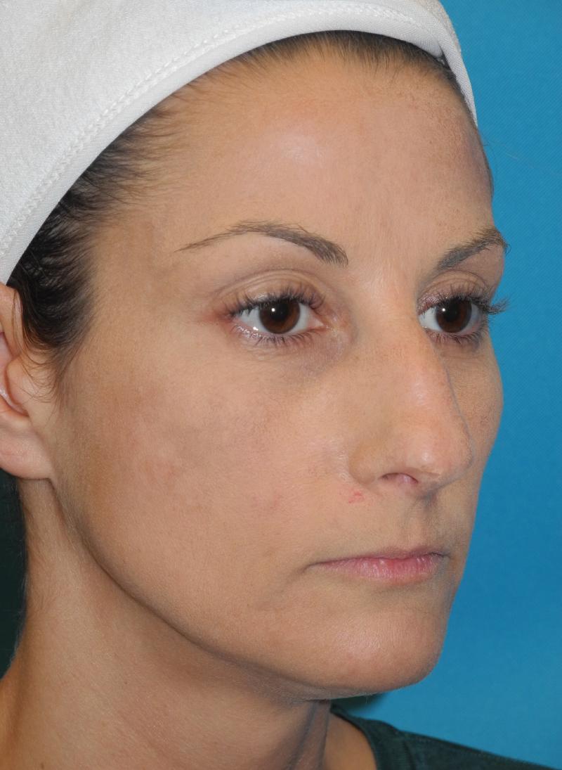 Rhinoplasty case #4123