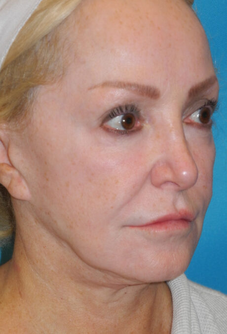 CO2 Laser Resurfacing case #4635