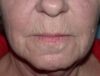 CO2 Laser Resurfacing case #4637