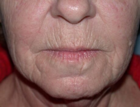 CO2 Laser Resurfacing case #4637