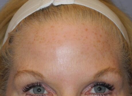 CO2 Laser Resurfacing case #4682