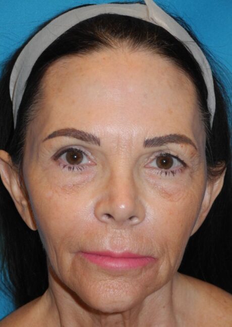 CO2 Laser Resurfacing case #4686