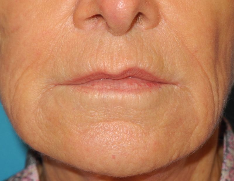 CO2 Laser Resurfacing case #4750