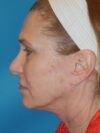 CO2 Laser Resurfacing case #4753