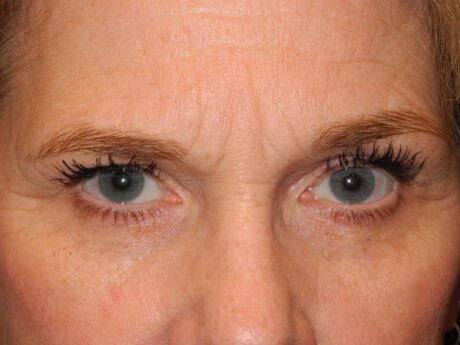 CO2 Laser Resurfacing case #4754