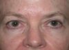 Blepharoplasty case #4831