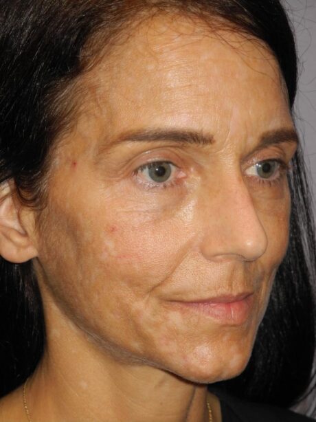 CO2 Laser Resurfacing case #4755