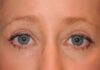 Blepharoplasty case #5003