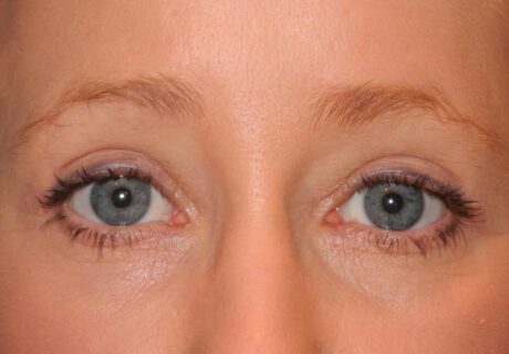 Blepharoplasty case #5003