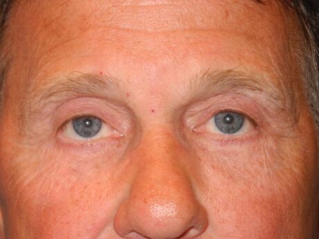 Blepharoplasty case #5018