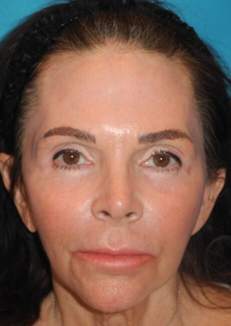 Blepharoplasty case #5186