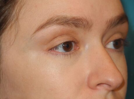 Blepharoplasty case #5197