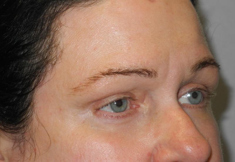 Blepharoplasty case #5225